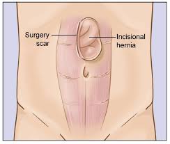 Beth Israel Hernia Center Incisional Hernia Hernia Surgeon Nyc Surgery Recovery Beth Israel Post Surgery