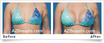 Expert Tips On Choosing The Best Breast Implant Size For Your Body | Dr.  Aldo's Blog