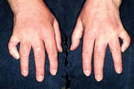 I also have curved pinkies!!! A Physical Deformity No Clinician Has Asked About Clinician Reviews