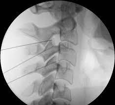 Ohne dass direkte schädigungen an der halswirbelsäule nachweisbar sind, entwickeln sich innerhalb von ca. Schleudertrauma Dr Med Walter Morgenstern