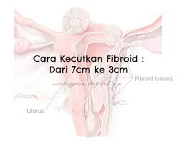 Jenis ketumbuhan yang paling biasa. Cara Kecutkan Fibroid Dari 7cm Ke 3cm Bebelsihat Com
