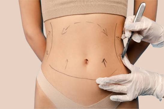 Waistline Liposuction | Liposuction Surgery in Dubai