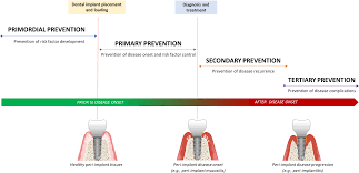 BSP Implementation of prevention and treatment of peri-implant diseases      The EFP S3 level clinical practice guideline