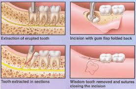 After wisdom teeth removal, you can also expect some bleeding for the first few hours. Best Wisdom Tooth Extraction Treatment Wisdom Teeth Removal Cost In India