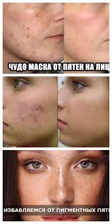 как убрать рубцы от прыщей на лице народные средства Recept Ochen Effektivnoj Maski Ot Lyubyh Pyaten Na Lice Beauty Skin Care Skin Beauty Face
