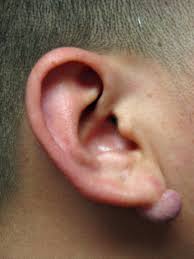 Use the menu to see other pages.staging is a way of describing where the cancer is located, if or where it has spread, and whethe. Recurrent Earlobe Keloid Scottsdale Phoenix Plastic Surgery