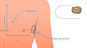 Indicato in pazienti giovani, senza gravi cardiopatie strutturali, ma a rischio di aritmie potenzialmente pericolose impiantato il primo defibrillatore sottocutaneo senza fili a biella video. S Icd Impara Le Differenze Dell Icd Sottocutaneo