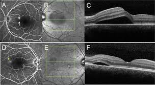 Maybe you would like to learn more about one of these? Central Serous Chorioretinopathy Recent Findings And New Physiopathology Hypothesis Sciencedirect
