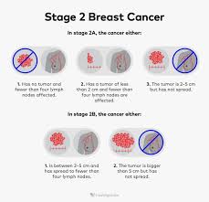 Image result for Breast Cancer Management