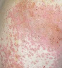 Image result for Atopic eczema atopic dermatitis