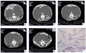 cystic mesothelioma of the retroperitoneum cystic mesothelioma of the retroperitoneum li, yuk‐pui; Pdf Abdominal Imaging Benign Multicystic Mesothelioma In A Man A Case Report Benign Multicystic Mesothelioma Semantic Scholar