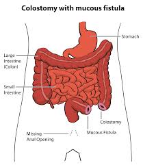 Pediatric Surgery Anorectal Malformation Pediatric Surgery Colostomy Pediatrics
