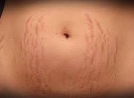 Setelah itu, oleskan ke bagian kulit yang. Cara Ampuh Menghilangkan Stretch Mark Dengan Cepat Aladokter