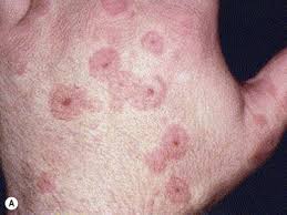 These conditions were first recognised in 1922. Erythema Multiforme Stevens Johnson Syndrome And Toxic Epidermal Necrolysis Clinical Gate