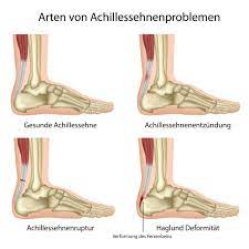 Fersenschmerz Symptom Verschiedener Erkrankungen