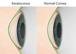 What Is Keratoconus The Eye Practice Lasik Surgery Lasik Eyes