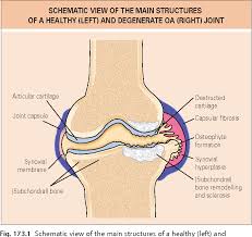 175 Pathogenesis And Pathology Of Osteoarthritis