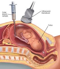 Image result for Fetal Testing Indications