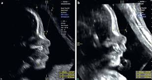 Assessment Of Midfacial Hypoplasia In Down Syndrome Fetuses Validity Of A Two Line Approach And Introduction Of A Novel Angle Maxilla Mandible Nasion Angle Abstract Europe Pmc