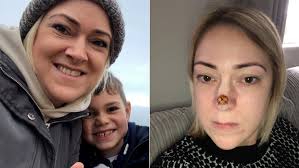 It's commonly found on your face, chest, arms, and hands. Skin Cancer Check Harmless Spot On Mum S Nose Was Diagnosed As Skin Cancer 7news Com Au