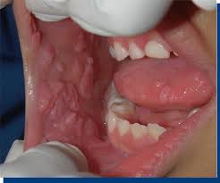 Image result for Labial mucosa