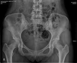 Pelvis Ap Digital X Ray Image Made By A Cr Unit X Ray Images Ice Tray Image