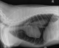 Image result for Pneumothorax