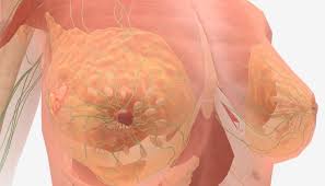 One of the first signs is most likely to be visible swelling (edema) of the skin of the breast and/or redness of the breast (covers more than 30. Stage 4 Breast Cancer Symptoms And Prognosis