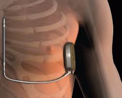 Después de que a christian se le hayan hecho varios exámenes cardíacos se ha decidido que se debería ponerle un dai (desfibrilador automático implantable). El Clinic Implanta El Primer Desfibrilador Sin Electrodos Intracardiacos En Cataluna Hospital Clinic Barcelona