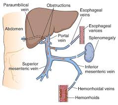 Anatomical diagram of portal hypertension: liver obstruction, collateral flow, esophageal varices, splenomegaly, and hemorrhoidal veins