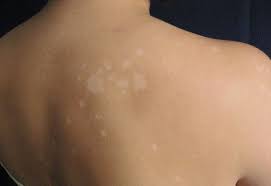 White Patches On Skin Green Basil Leaves Paste Take Vit B12 White Skin Patches Skin Spots Health Skin Care