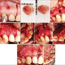 Pdf Treatment Of Lateral Periodontal Cyst With Guided Tissue Regeneration