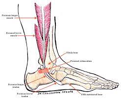Diagnosis can be determined by a positive bone scan in medial edge of patella (dutton). Peroneal Tendon Subluxation Doc