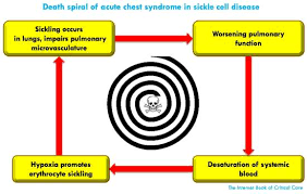 Sickle Cell Acute Chest Syndrome Emcrit Project