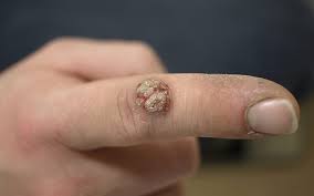 Hpv Warze Mund Simptomele Helmintiazei Hpv Warzen Im Mund