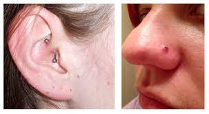 Lumps Bumps On Piercings Pictures Of Lily