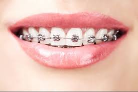 How long your braces are on depends on the severity of the problem. Never Too Old For Braces Tony Weir Orthodontics