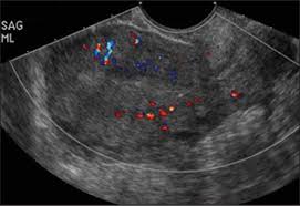 Learn an ultrasound procedure, and conditions and diseases it assists in diagnosing and screening like tumors, cysts, heart for what purposes are ultrasounds used? Retained Products Of Conception Kamaya 2009 Journal Of Ultrasound In Medicine Wiley Online Library