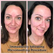 Dealing with sunburns after wrestling