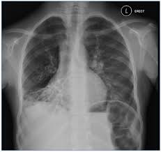 A parte do raio x de tórax, foi verificado. Residencia Pediatrica Leituras De Radiografias De Torax Em Criancas Suspeitas De Possuir Tuberculose Pulmonar