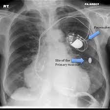 Pacemaker and implantable cardioverter defibrillator (icd) insertion. Chest X Ray Of The Patient Showing The Pacemaker In Situ And The Download Scientific Diagram