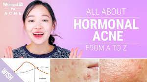 Other remedies for hormonal acne add one tablespoon of turmeric to a glass of hot milk and consume it every night before going to bed apply the paste of baking soda and water on the affected areas of the body. How To Cure Hormonal Acne Lifestyle Skincare Tips Wishtrend Tv Vs Acne Youtube