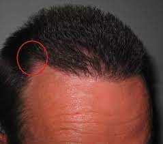 Die aktive phase einer haarwurzel (anagenphase) dauert zwei bis sechs jahre. Zu Wenig Haare An Dieser Stelle Siehe Bild Gesundheit Arzt Haut