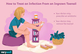Maybe you would like to learn more about one of these? Ingrown Nail Surgery Preparation Procedure Recovery