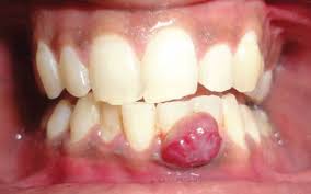 Image result for granuloma gum disease