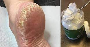 Ways To Prevent And Get Rid Of Dry Cracked Feet This Winter