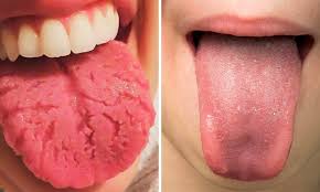 The Tongue Diagnosis Stems From The Ancient Medical Practice Of Ayurveda A System That Supports Overall Health Th Healthy Tongue Health Health And Beauty Tips
