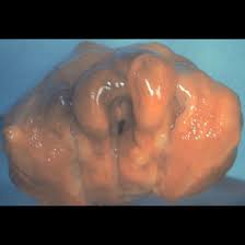 Image result for Epiglottitis