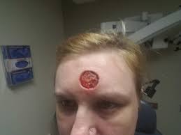 Understanding the symptoms and the risks associated with each type of skin cancer will help you determine the right course of treatment. Skin Cancer Removal Album On Imgur