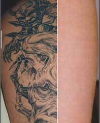 I was told they usually only do 3 to 4 hour tattoo sessions so the pain doesn't reach the point of becoming unbearable. Does Laser Tattoo Removal Hurt